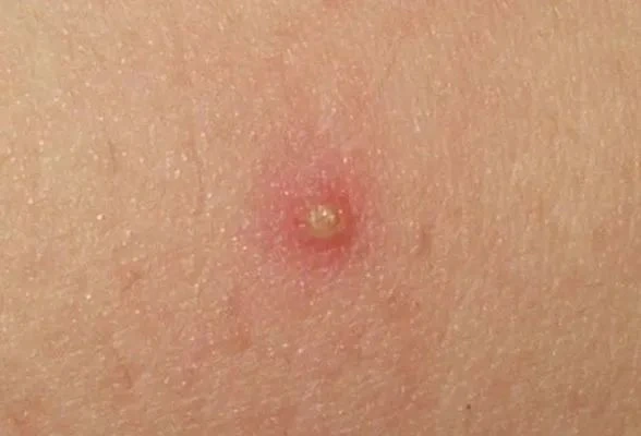 Mupirocin